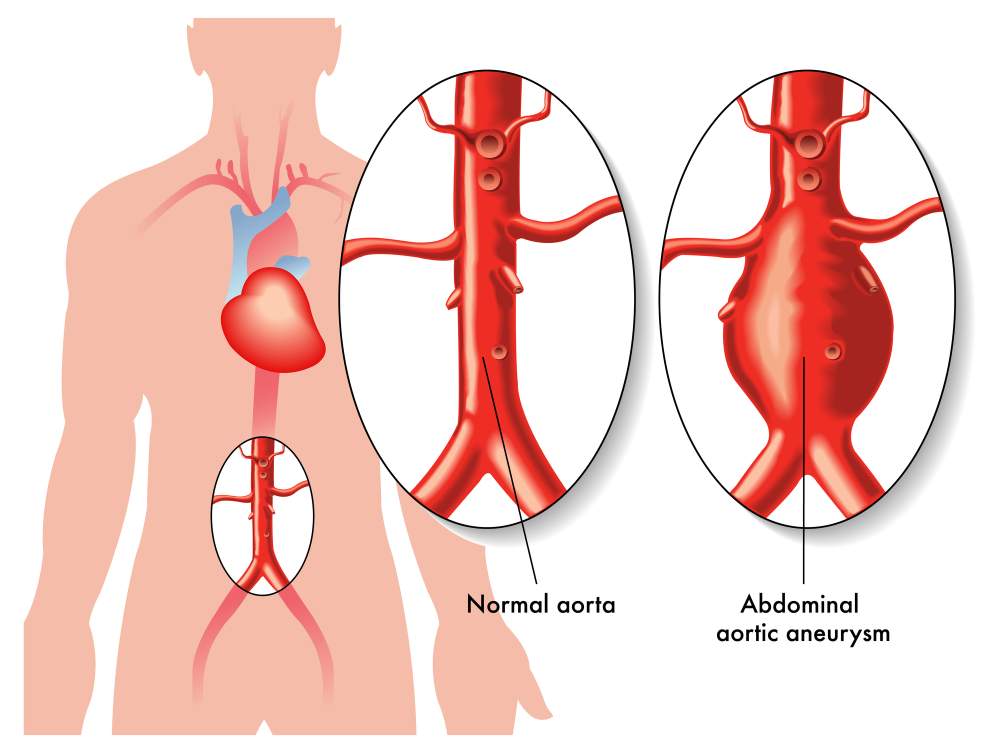 Abdominal Aortic Aneurysm – The triple A to avoid