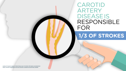 Carotid Artery Disease