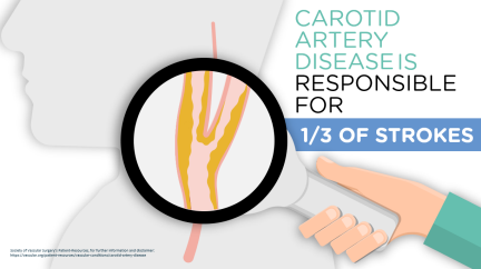 Why Do I Have Carotid Artery Disease?