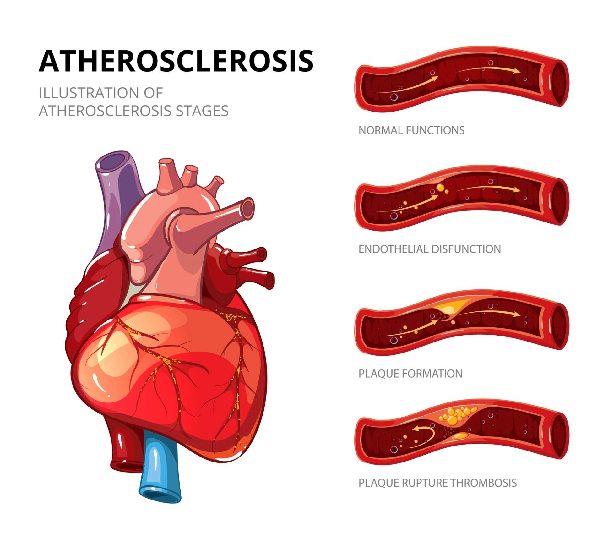 Carotid Artery Disease