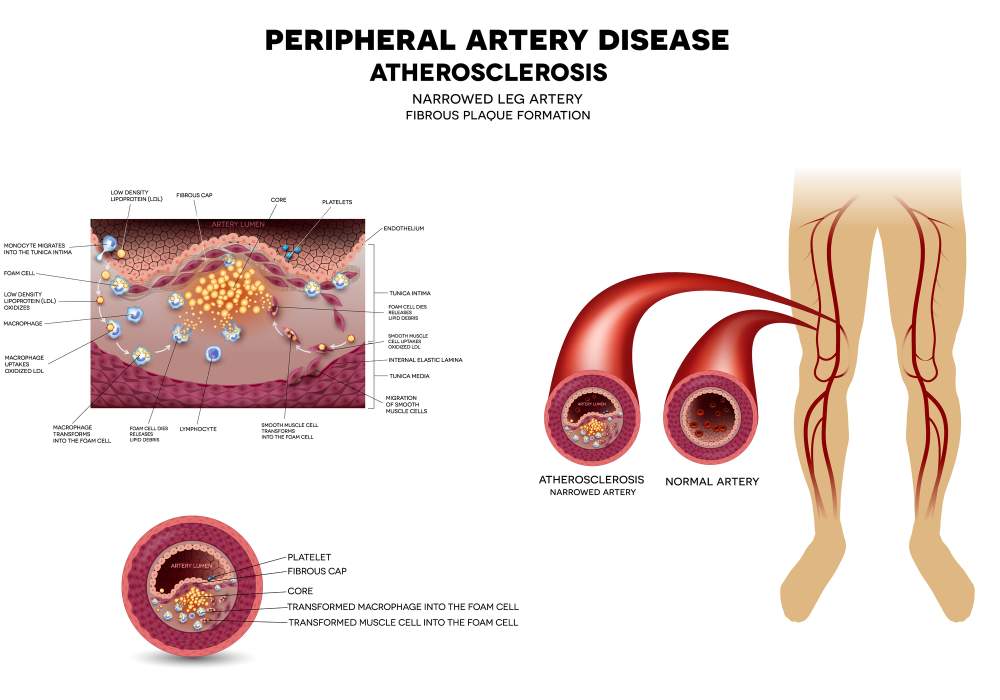 Peripheral artery disease – A common and costly vascular issue