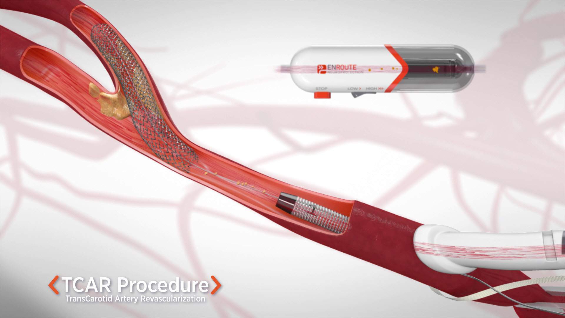 TCAR Procedure